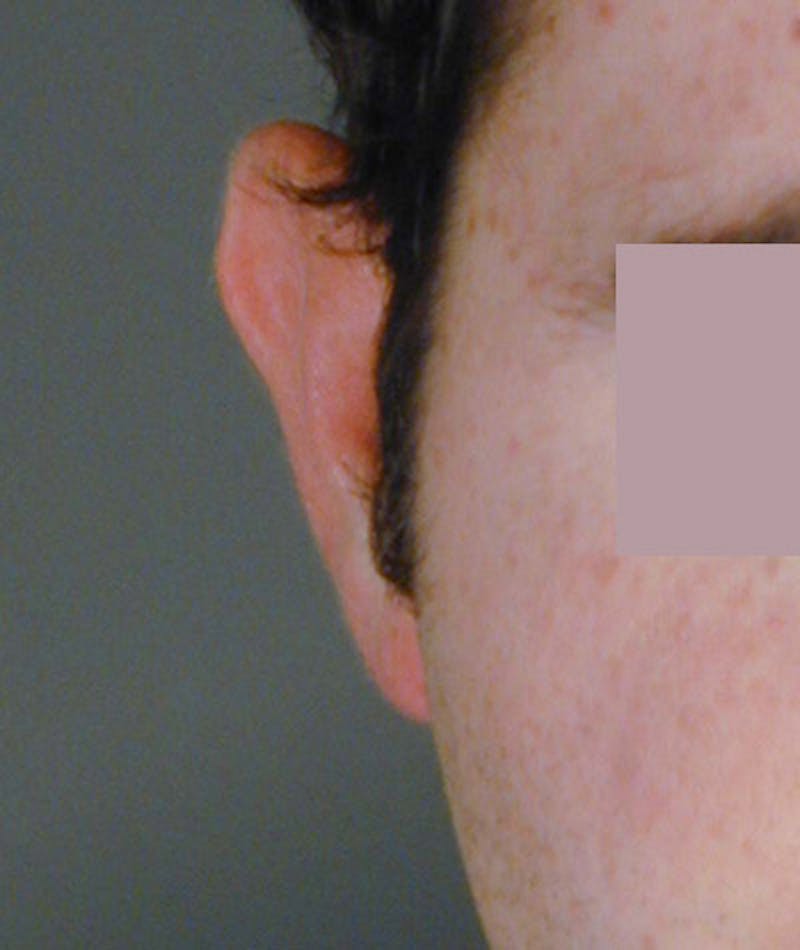 Otoplasty Before & After Gallery - Patient 108435054 - Image 3