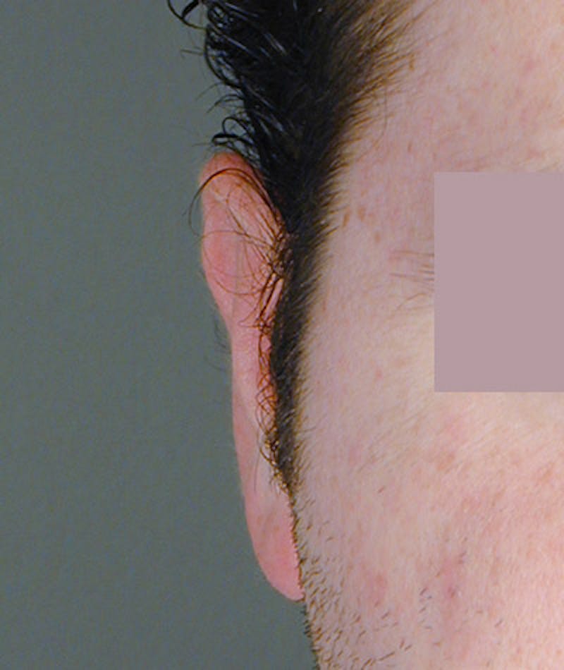 Otoplasty Before & After Gallery - Patient 108435054 - Image 4