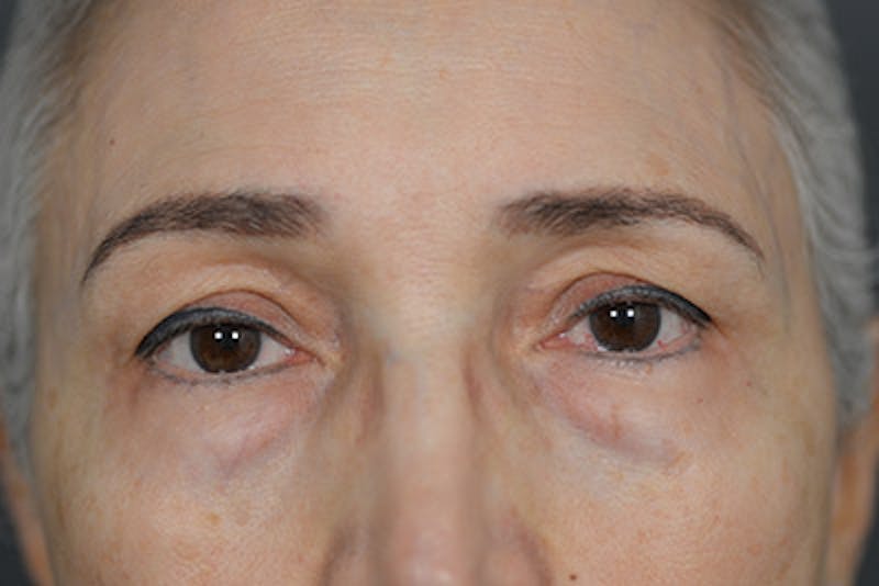 Lower Blepharoplasty Before & After Gallery - Patient 108441285 - Image 1