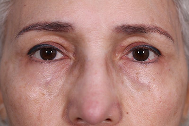 Lower Blepharoplasty Before & After Gallery - Patient 108441285 - Image 2