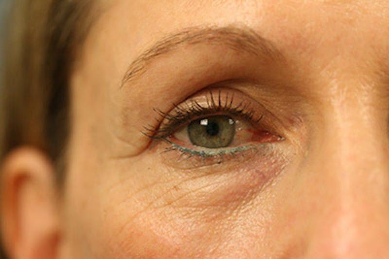 Lower Blepharoplasty Before & After Gallery - Patient 108441292 - Image 1