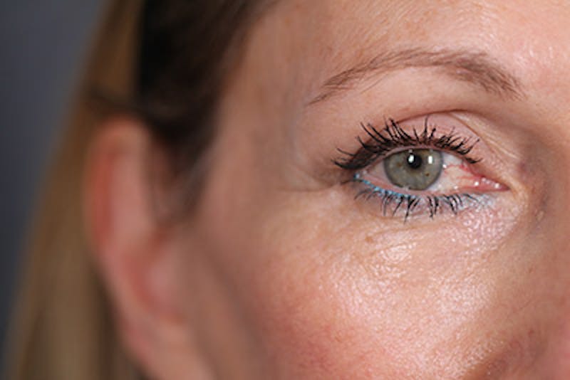 Lower Blepharoplasty Before & After Gallery - Patient 108441292 - Image 2