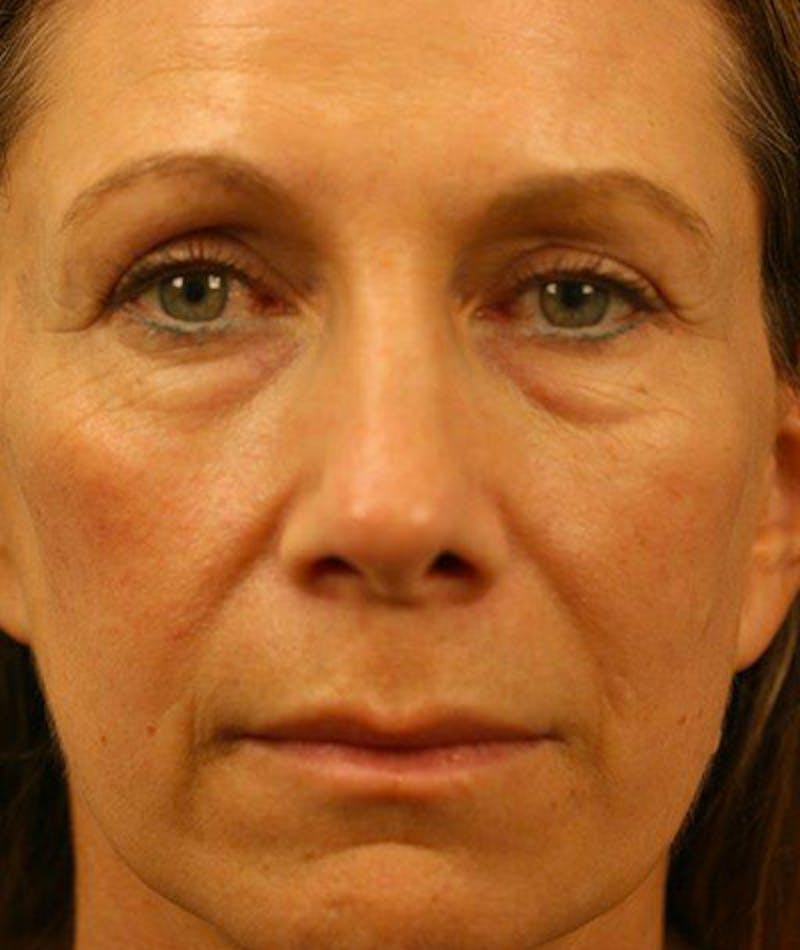 Lower Blepharoplasty Before & After Gallery - Patient 108441292 - Image 3