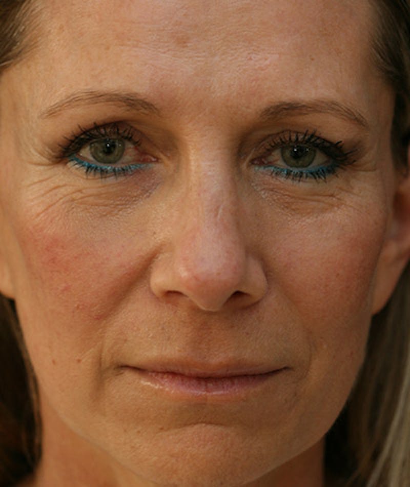 Lower Blepharoplasty Before & After Gallery - Patient 108441292 - Image 4