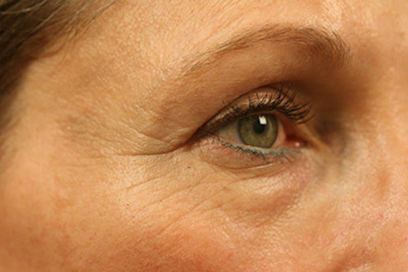 Lower Blepharoplasty Gallery - Patient 108441292 - Image 5