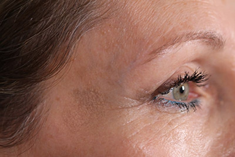 Lower Blepharoplasty Before & After Gallery - Patient 108441292 - Image 6