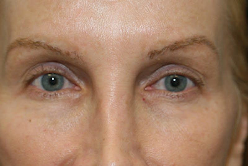 Upper Blepharoplasty Before & After Gallery - Patient 108442968 - Image 1