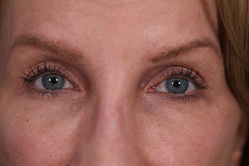 Upper Blepharoplasty Before & After Gallery - Patient 108442968 - Image 2