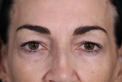 Before & After eyelid surgery in Beverly Hills with Dr. Nassif