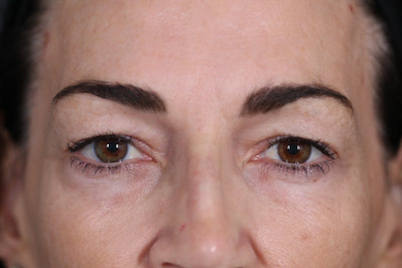 Upper Blepharoplasty Before & After Gallery - Patient 108443006 - Image 1