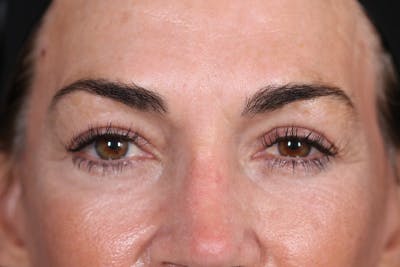 Before & After eyelid surgery in Beverly Hills with Dr. Nassif
