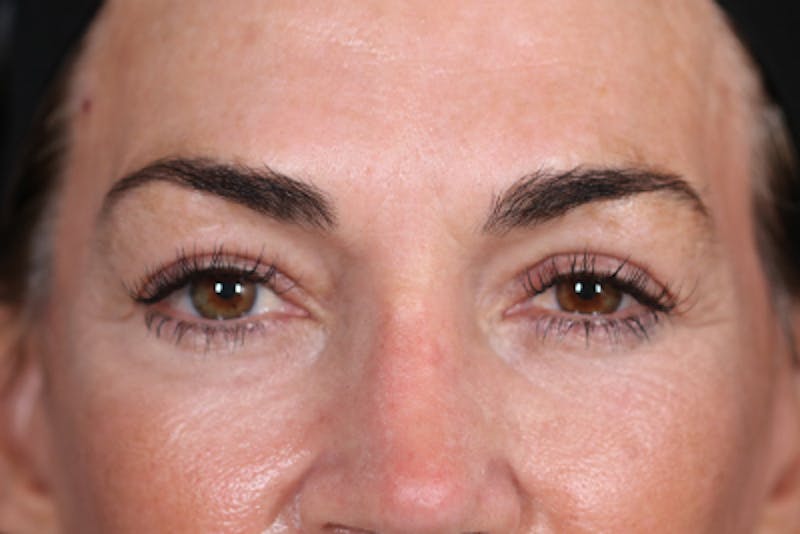 Upper Blepharoplasty Before & After Gallery - Patient 108443006 - Image 2