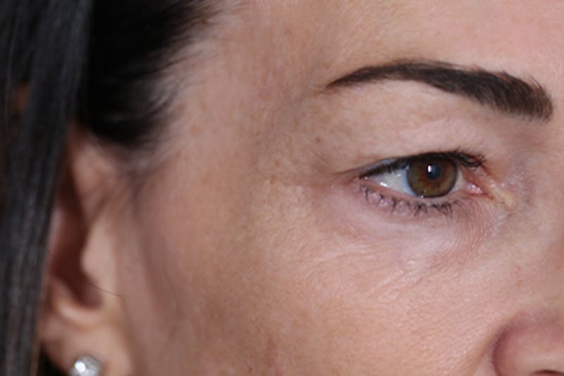 Upper Blepharoplasty Before & After Gallery - Patient 108443006 - Image 3