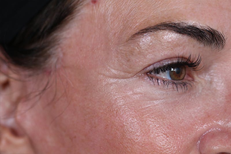Upper Blepharoplasty Before & After Gallery - Patient 108443006 - Image 4