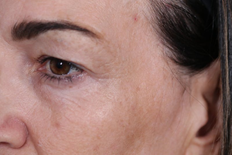 Upper Blepharoplasty Before & After Gallery - Patient 108443006 - Image 5