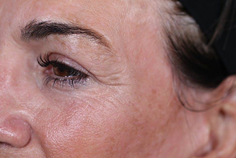 Upper Blepharoplasty Before & After Gallery - Patient 108443006 - Image 6