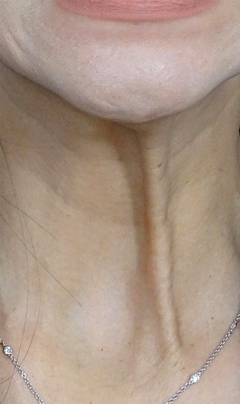 BOTOX Before & After Gallery - Patient 108443082 - Image 1