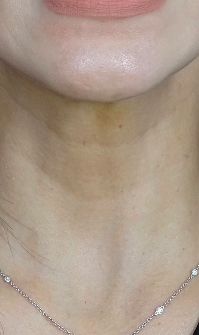 BOTOX Before & After Gallery - Patient 108443082 - Image 2