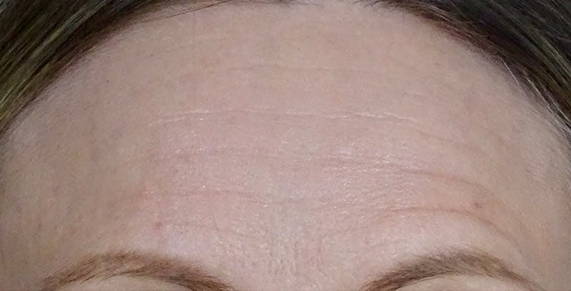 BOTOX Before & After Gallery - Patient 108443092 - Image 1