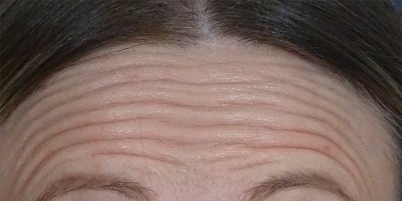 BOTOX Before & After Gallery - Patient 108443102 - Image 1