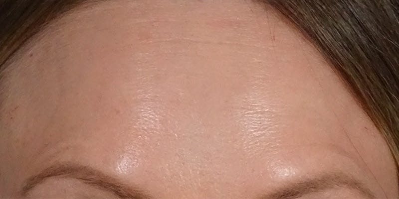 BOTOX Before & After Gallery - Patient 108443102 - Image 2