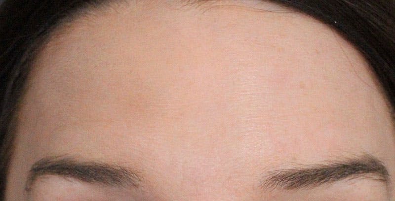 BOTOX Before & After Gallery - Patient 108443106 - Image 2