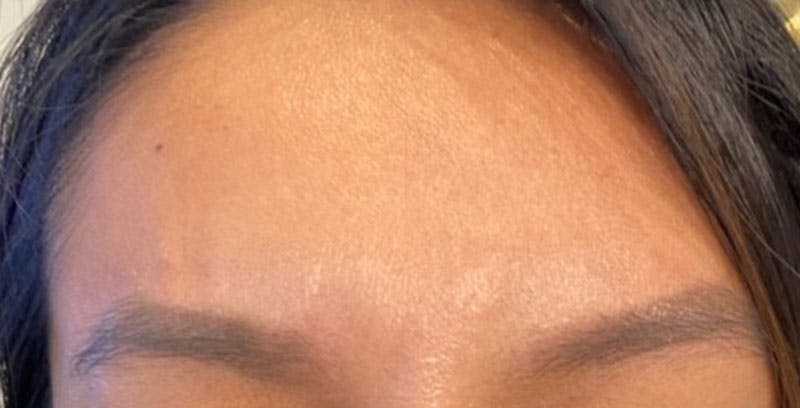 BOTOX Before & After Gallery - Patient 108443114 - Image 2