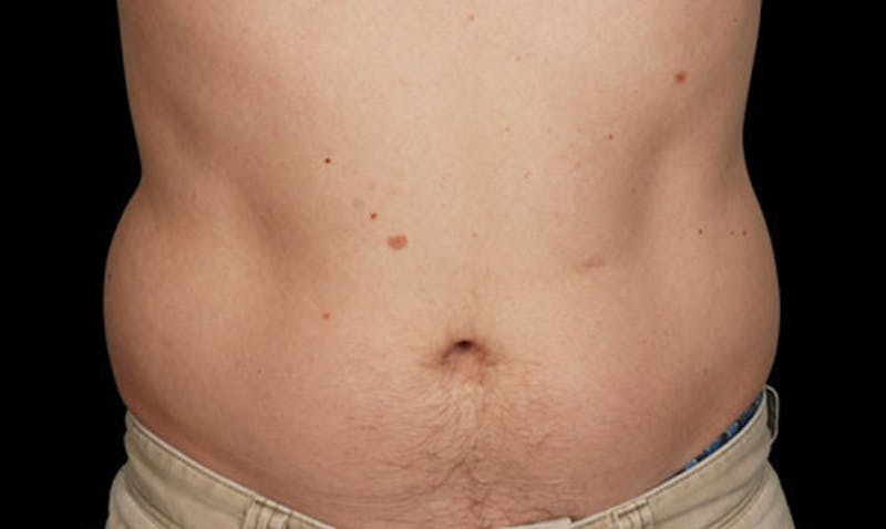 CoolSculpting Gallery - Patient 108443173 - Image 1