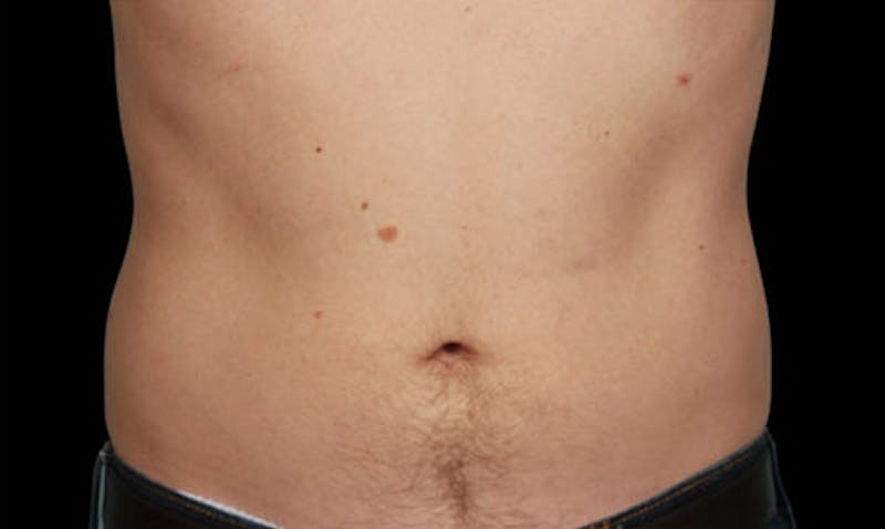 CoolSculpting Before & After Gallery - Patient 108443173 - Image 2
