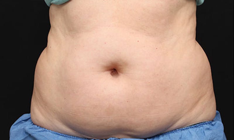 CoolSculpting Before & After Gallery - Patient 108443180 - Image 1