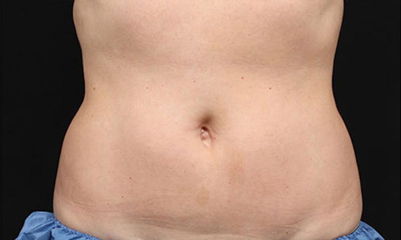 CoolSculpting Before & After Gallery - Patient 108443180 - Image 2