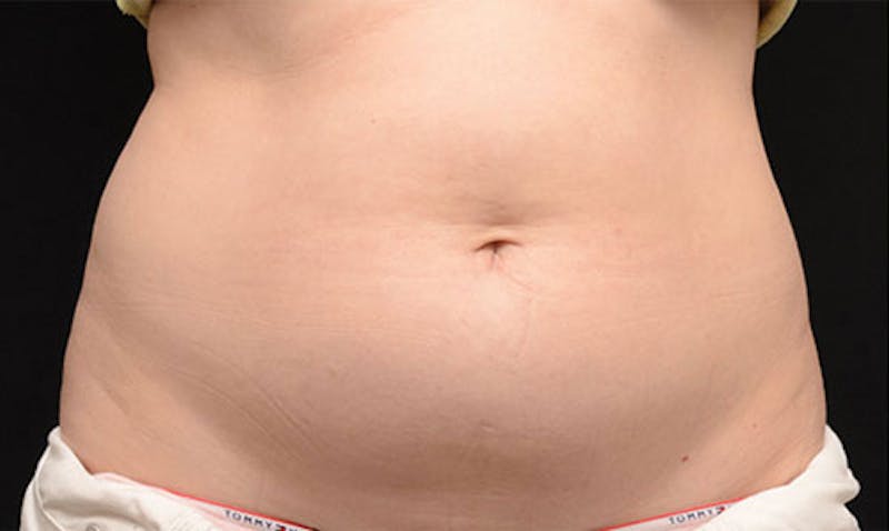 CoolSculpting Before & After Gallery - Patient 108443190 - Image 1