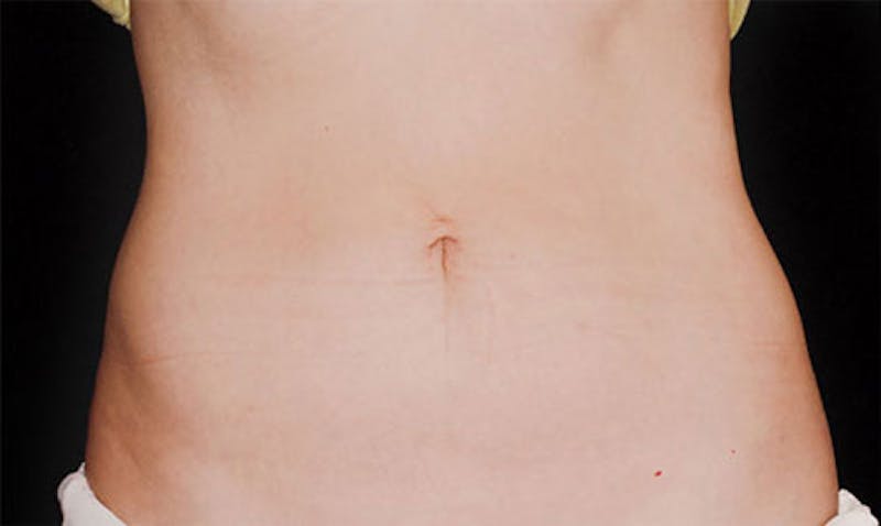 CoolSculpting Before & After Gallery - Patient 108443190 - Image 2