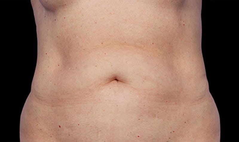 CoolSculpting Before & After Gallery - Patient 108443199 - Image 1
