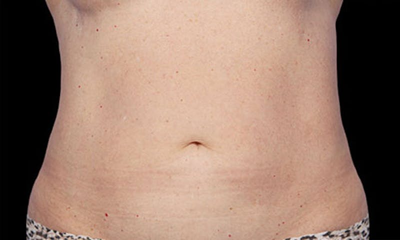 CoolSculpting Before & After Gallery - Patient 108443199 - Image 2