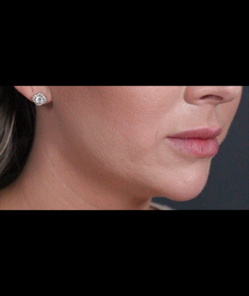 Fillers Before & After Gallery - Patient 108443236 - Image 1