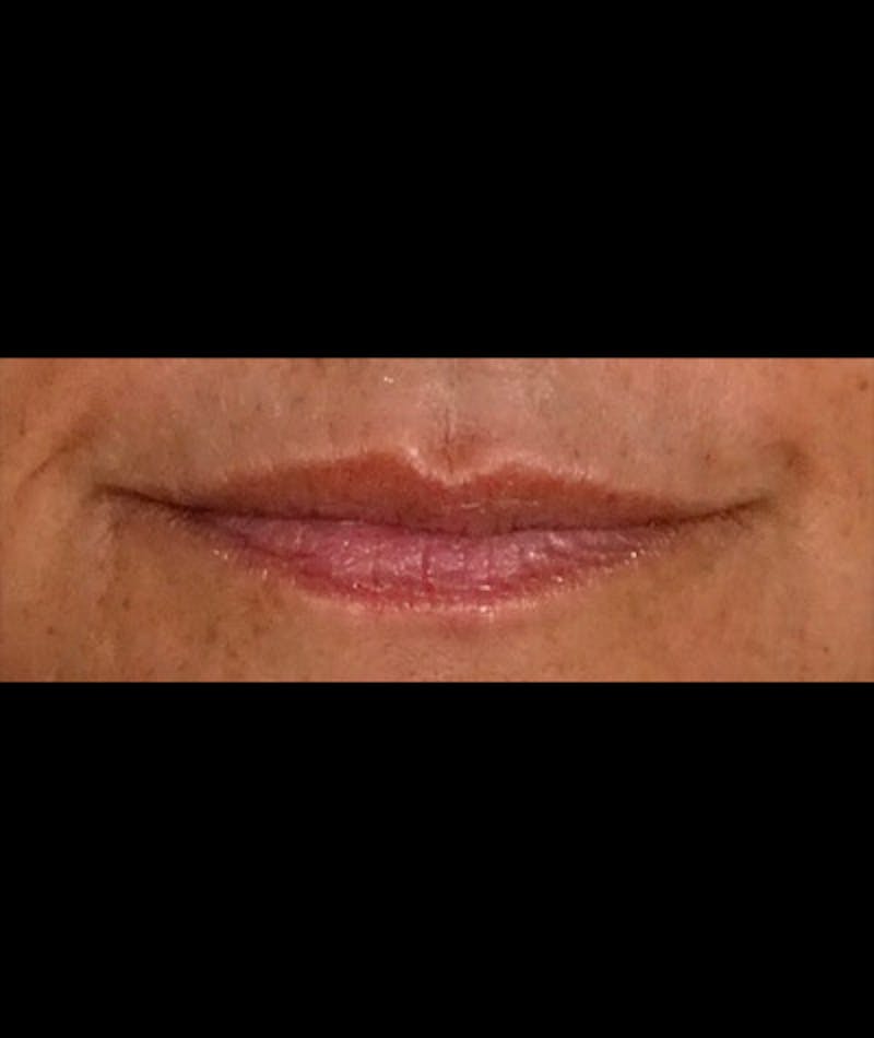 Fillers Before & After Gallery - Patient 108443244 - Image 1