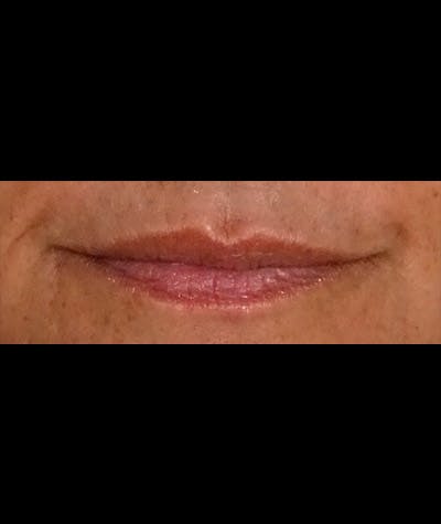 Fillers Before & After Gallery - Patient 108443244 - Image 1