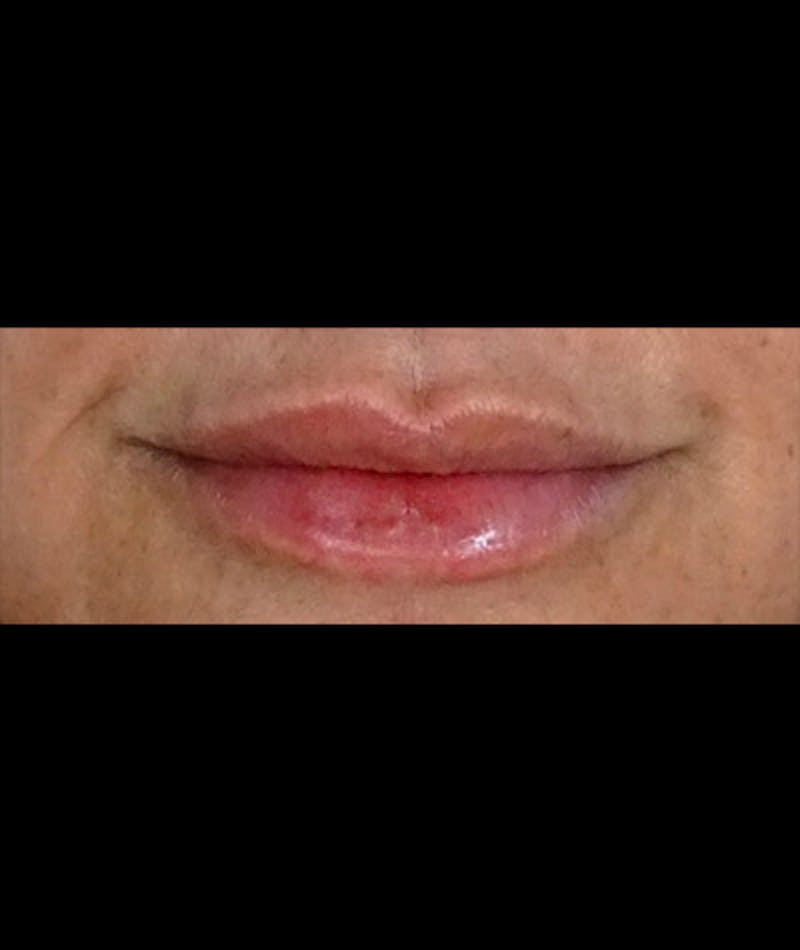 Fillers Before & After Gallery - Patient 108443244 - Image 2