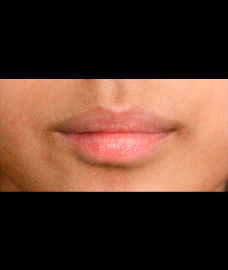 Fillers Before & After Gallery - Patient 108443246 - Image 1