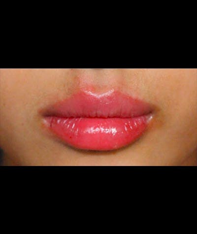 Fillers Before & After Gallery - Patient 108443246 - Image 2