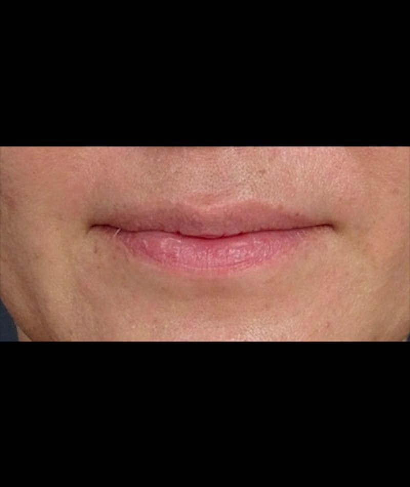 Fillers Before & After Gallery - Patient 108443248 - Image 1