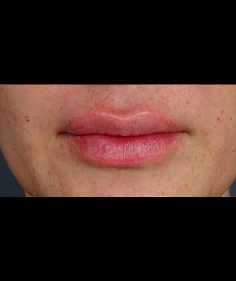 Fillers Before & After Gallery - Patient 108443248 - Image 2