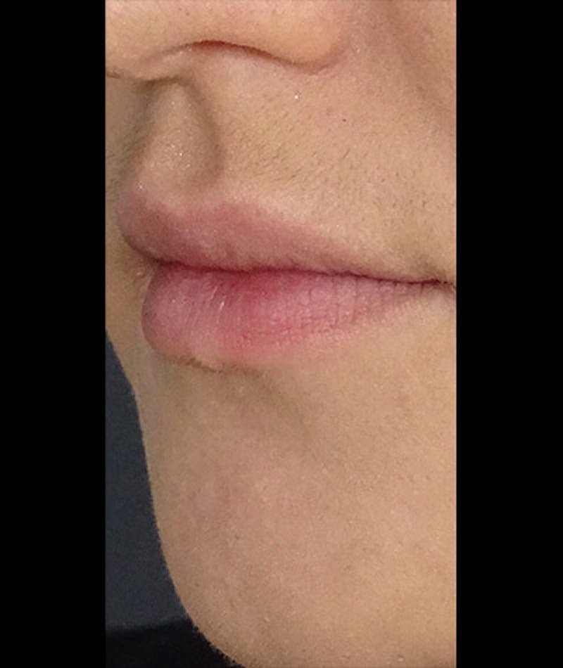 Fillers Before & After Gallery - Patient 108443249 - Image 1