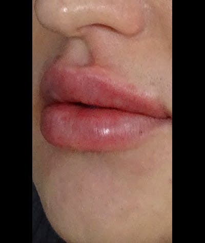 Fillers Before & After Gallery - Patient 108443249 - Image 2