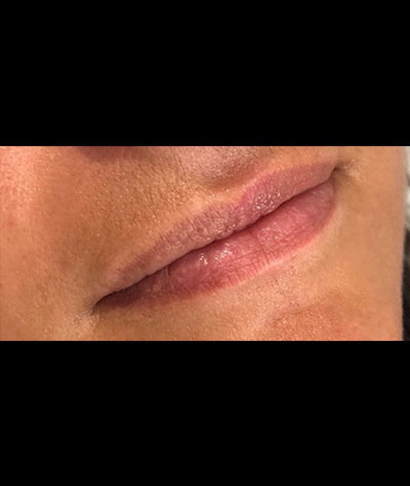 Fillers Before & After Gallery - Patient 108443251 - Image 1