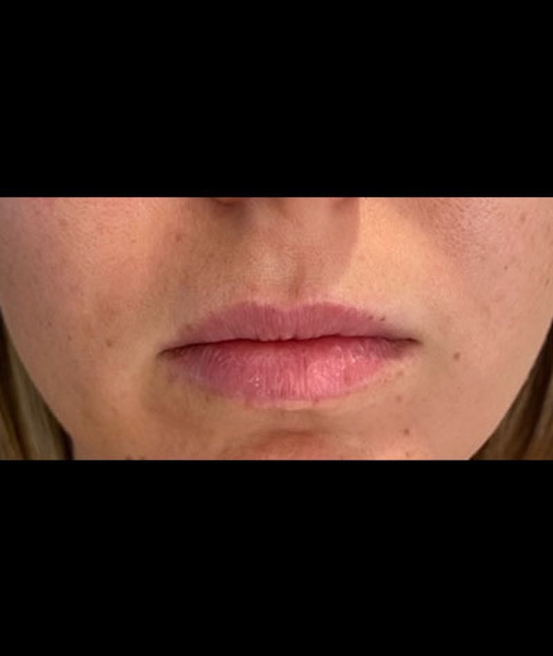 Fillers Before & After Gallery - Patient 108443253 - Image 1