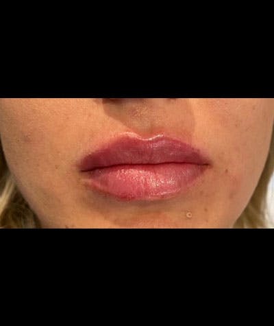 Fillers Before & After Gallery - Patient 108443253 - Image 2