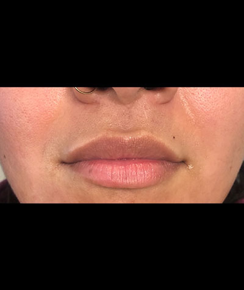 Fillers Before & After Gallery - Patient 108443255 - Image 1