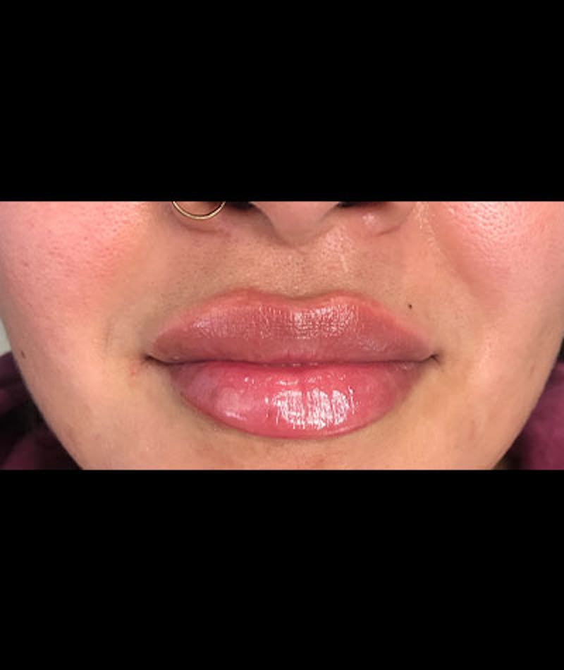 Fillers Before & After Gallery - Patient 108443255 - Image 2